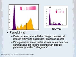 • Penyakit Hati :
– Pasien laki-laki, umur 46 tahun dengan penyakit hati
stadium akhir yang disebabkan kecanduan alkohol.
– Pada gambaran sirosis, batas lekukan antara beta dan
gamma kabur dan kadang digambarkan sebagai
gambaran jembatan "beta-gamma”
Normal
http://erl.pathology.iupui.edu/labmed/Generator.cfm?Image=SPE
 