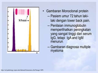 • Gambaran Monoclonal protein
– Pasiem umur 72 tahun laki-
laki dengan lower back pain.
– Penilaian immunoglobulin
memperlihatkan peningkatan
yang sangat tinggi dari serum
IgG, tetapi IgA and IgM
menurun.
– Gambaran diagnosa multiple
myeloma
http://erl.pathology.iupui.edu/labmed/Generator.cfm?Image=SPE
 