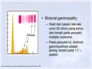 • Biclonal gammopathy
– Hasil dari pasien laki-laki
umur 62 tahun yang kurus
dan lemah pada penyakit
multiple myeloma.
– Pada penyakit ini, biclonal
gammopathies adalah
jarang, terjadi pada 1,7 %
pasien.
http://erl.pathology.iupui.edu/labmed/Generator.cfm?Image=SPE
 