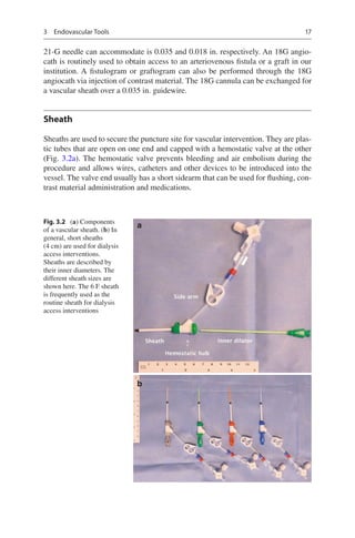 Dialysis Access Management 2nd Edition Steven Wu Sanjeeva Kalva | PDF