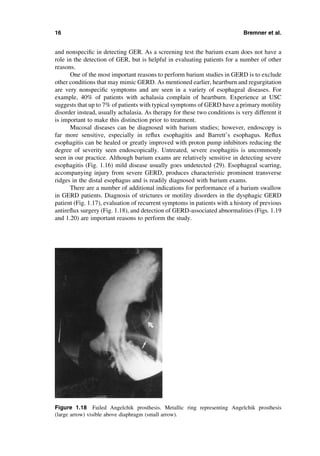 Esophageal Disease And Testing C G Bremner | PDF
