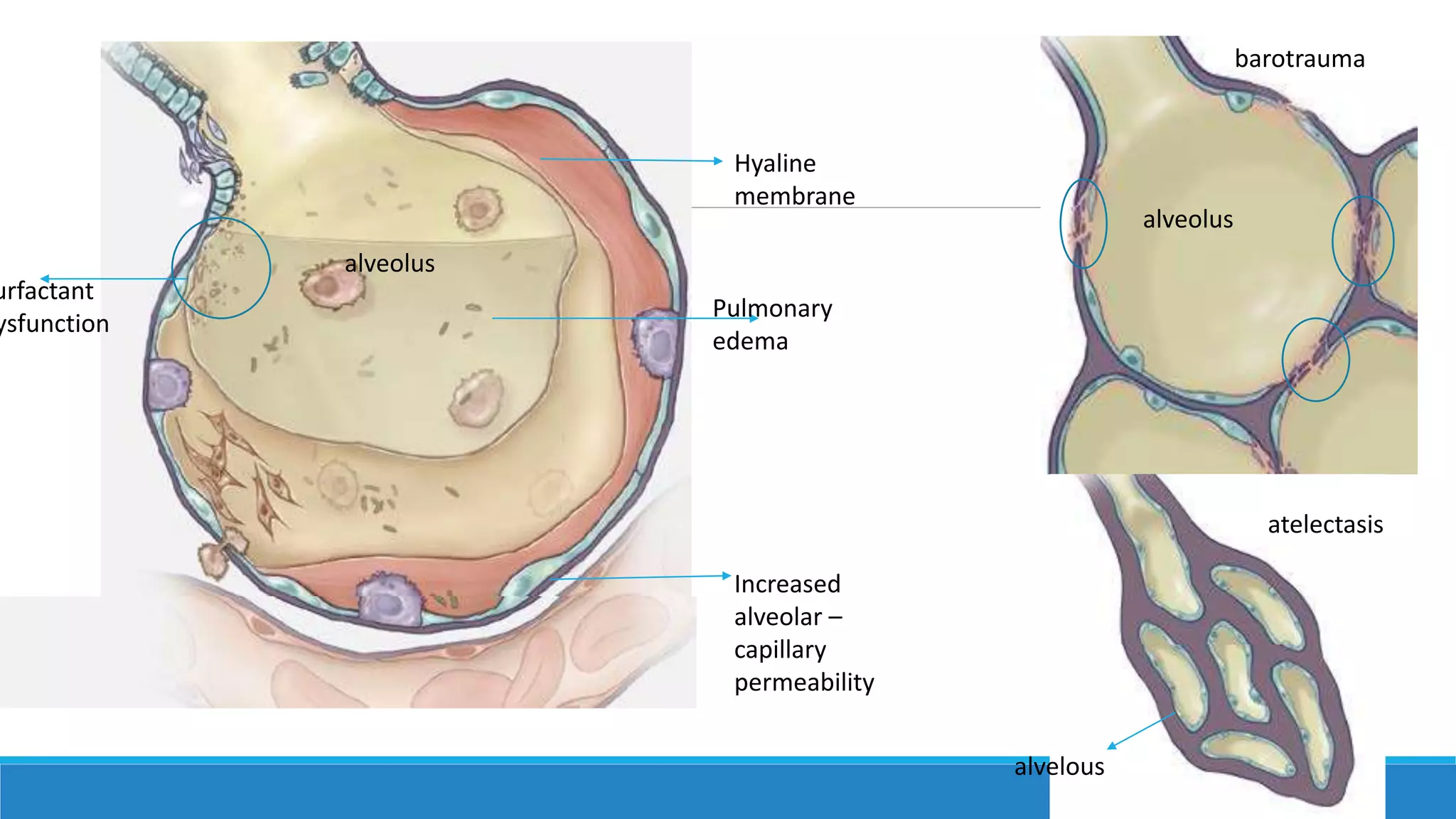 Hyaline
membrane
Pulmonary
edema
Increased
alveolar –
capillary
permeability
urfactant
ysfunction
alveolus
alveolus
barotrauma
alvelous
atelectasis
 