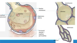 Hyaline
membrane
Pulmonary
edema
Increased
alveolar –
capillary
permeability
urfactant
ysfunction
alveolus
alveolus
barotrauma
alvelous
atelectasis
 