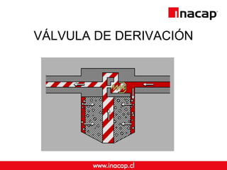 VÁLVULA DE DERIVACIÓN 
 