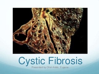 Cystic FibrosisPresented by Ofori-Addo, Eugene
 