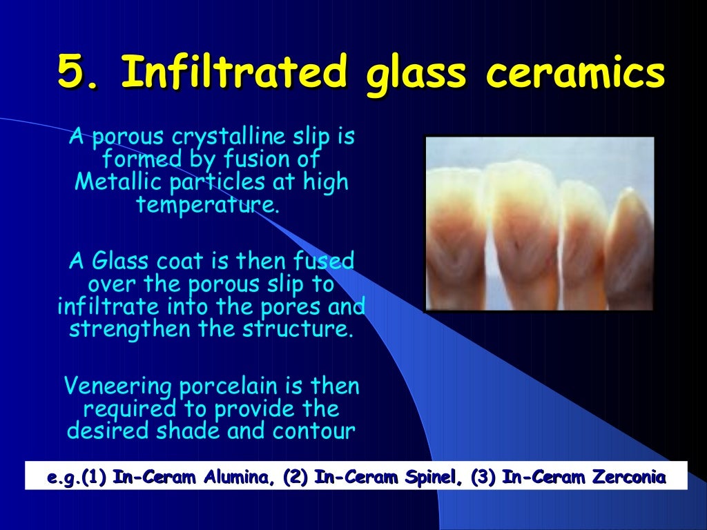 DENTAL CERAMICS Dental Porcelain AllCERAMIC RESTORATIONS dental mate…