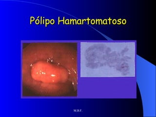 Pólipo Hamartomatoso 