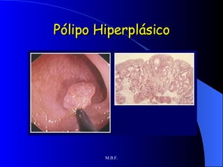 Pólipo Hiperplásico 