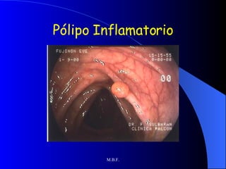 Pólipo Inflamatorio 