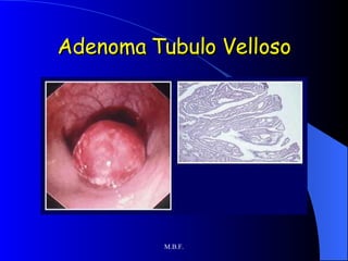 Adenoma Tubulo Velloso 