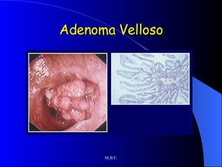 Adenoma Velloso 