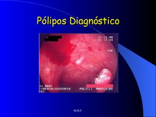 Pólipos Diagnóstico 