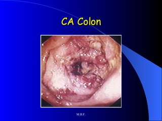 CA Colon 