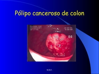 Pólipo canceroso de colon 