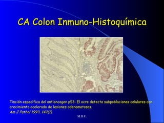 CA Colon Inmuno-Histoquímica Tinción específica del antioncogen p53: El ocre detecta subpoblaciones celulares con crecimiento acelerado de lesiones adenomatosas. Am J Pathol 1993. 142(1) 