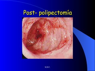 Post- polipectomía 