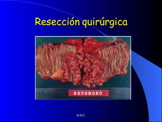 Resección quirúrgica 