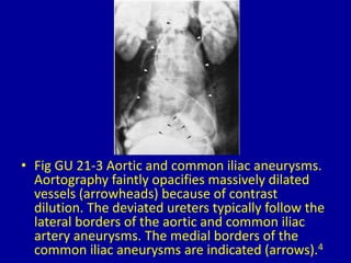 • Fig GU 21-3 Aortic and common iliac aneurysms.
Aortography faintly opacifies massively dilated
vessels (arrowheads) because of contrast
dilution. The deviated ureters typically follow the
lateral borders of the aortic and common iliac
artery aneurysms. The medial borders of the
common iliac aneurysms are indicated (arrows).4
 