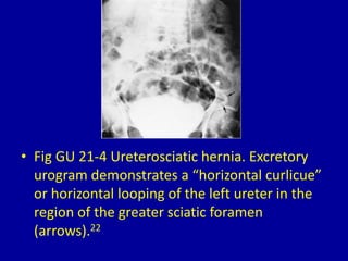 • Fig GU 21-4 Ureterosciatic hernia. Excretory
urogram demonstrates a “horizontal curlicue”
or horizontal looping of the left ureter in the
region of the greater sciatic foramen
(arrows).22
 