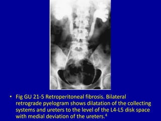 • Fig GU 21-5 Retroperitoneal fibrosis. Bilateral
retrograde pyelogram shows dilatation of the collecting
systems and ureters to the level of the L4-L5 disk space
with medial deviation of the ureters.4
 