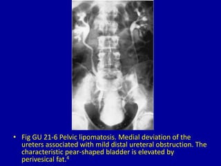 • Fig GU 21-6 Pelvic lipomatosis. Medial deviation of the
ureters associated with mild distal ureteral obstruction. The
characteristic pear-shaped bladder is elevated by
perivesical fat.4
 