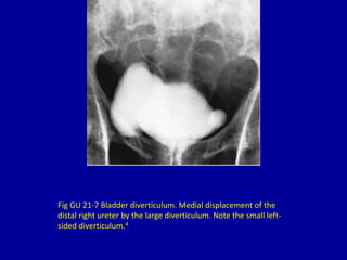 Fig GU 21-7 Bladder diverticulum. Medial displacement of the
distal right ureter by the large diverticulum. Note the small left-
sided diverticulum.4
 