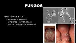 FUNGOS
 DEUTEROMICETOS
 PROPAGAM POR ESPOROS
 CANDIDÍASE – CANDIDA ALBICANS
 FRIEIRA – TRYCOPHYTON PURPUREUM
 