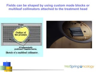 Fields can be shaped by using custom made blocks or multileaf collimators attached to the treatment head l 