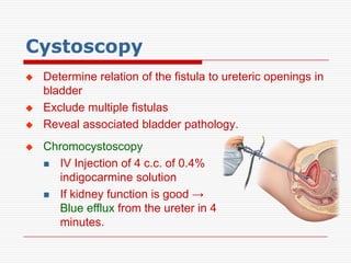 Cystoscopy
   Determine relation of the fistula to ureteric openings in
    bladder
   Exclude multiple fistulas
   Reveal associated bladder pathology.
   Chromocystoscopy
     IV Injection of 4 c.c. of 0.4%
      indigocarmine solution
     If kidney function is good →
      Blue efflux from the ureter in 4
      minutes.
 