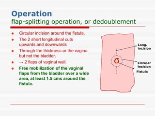 Operation
flap-splitting operation, or dedoublement
   Circular incision around the fistula.
   The 2 short longitudinal cuts
    upwards and downwards                   Long.
                                            incision
   Through the thickness or the vagina
    but not the bladder.
   → 2 flaps of vaginal wall.              Circular
                                            incision
   Free mobilization of the vaginal
                                            Fistula
    flaps from the bladder over a wide
    area, at least 1.5 cms around the
    fistula.
 