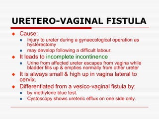 URETERO-VAGINAL FISTULA
   Cause:
       Injury to ureter during a gynaecological operation as
        hysterectomy
       may develop following a difficult labour.
   It leads to incomplete incontinence
       Urine from affected ureter escapes from vagina while
        bladder fills up & empties normally from other ureter
   It is always small & high up in vagina lateral to
    cervix.
   Differentiated from a vesico-vaginal fistula by:
       by methylene blue test.
       Cystoscopy shows ureteric efflux on one side only.
 