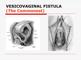 VESICOVAGINAL FISTULA
(The Commonest)
 