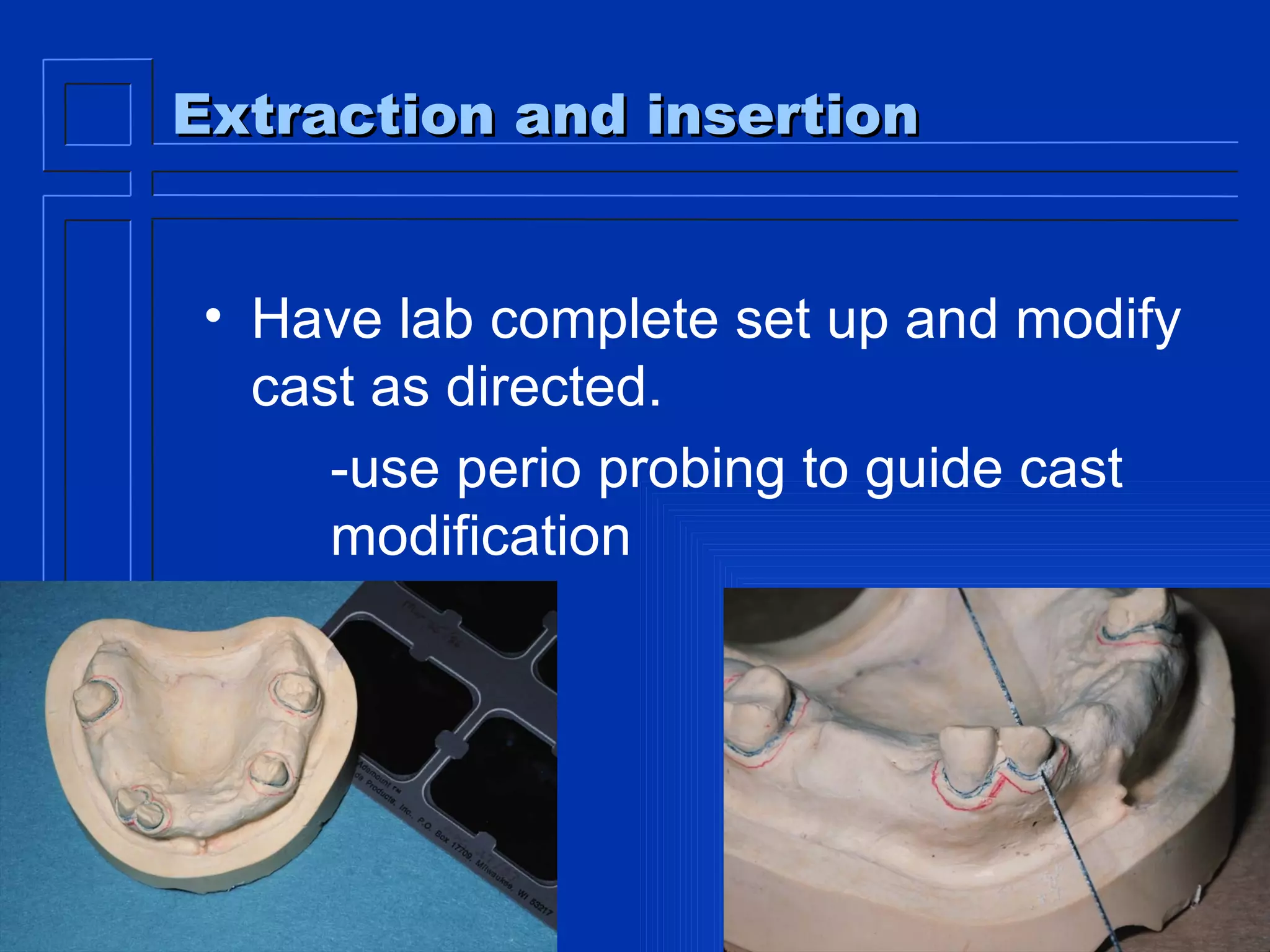 Extraction and insertion Have lab complete set up and modify cast as directed. -use perio probing to guide cast  modification 