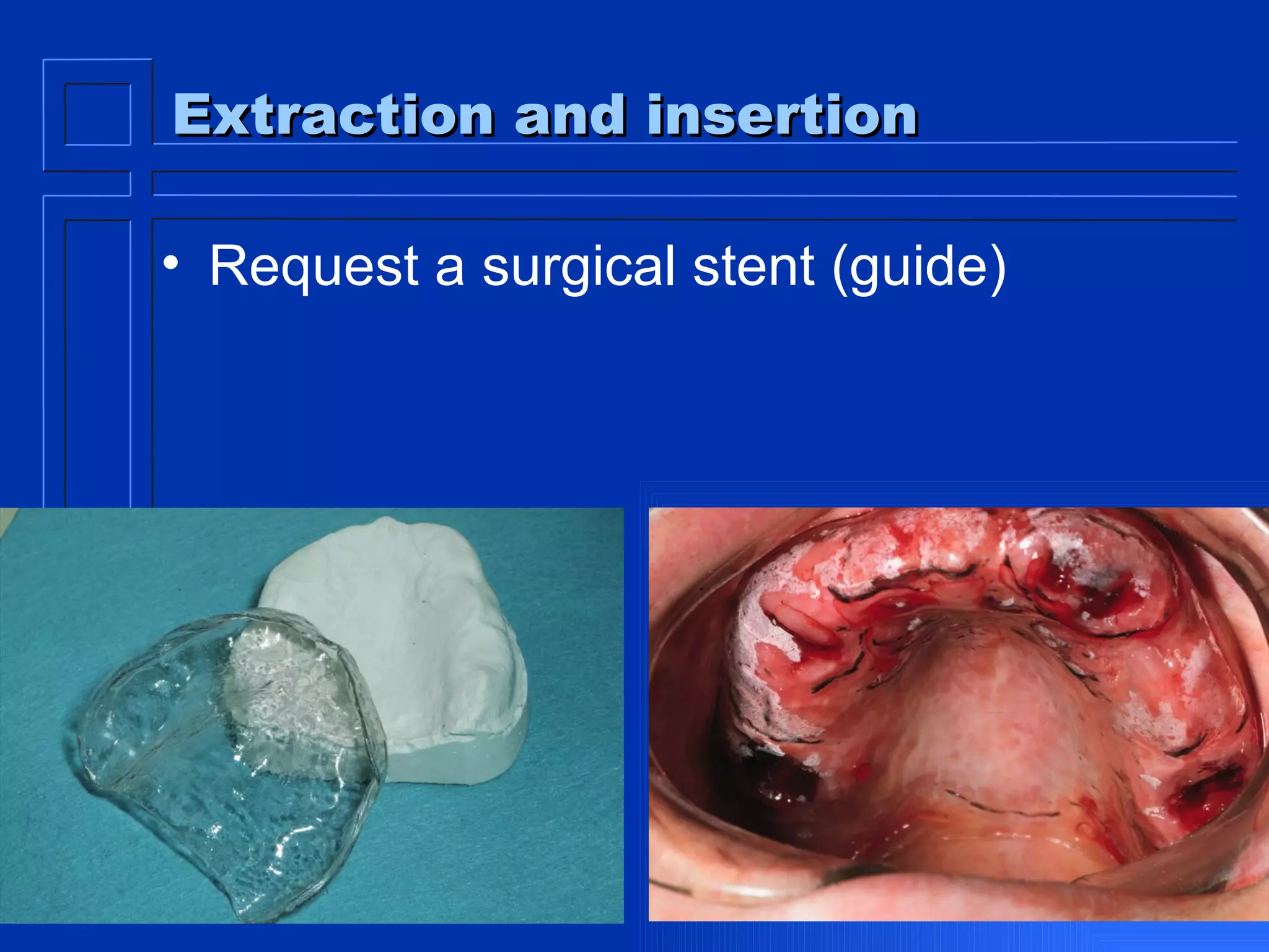 Extraction and insertion Request a surgical stent (guide) 