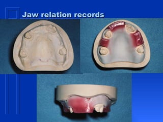 Jaw relation records 