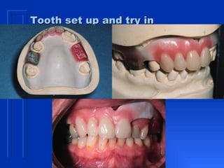 Tooth set up and try in 