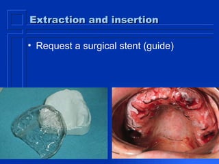 Extraction and insertion Request a surgical stent (guide) 