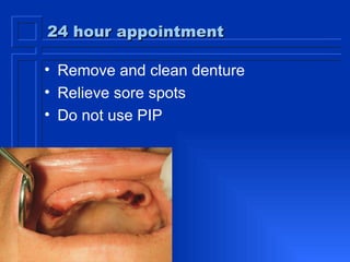 24 hour appointment Remove and clean denture Relieve sore spots Do not use PIP 