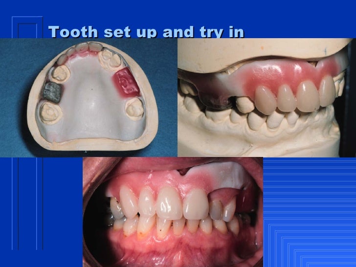immediate denture