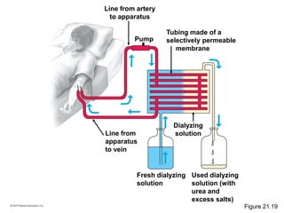 Used dialyzing
solution (with
urea and
excess salts)
Line from
apparatus
to vein
Fresh dialyzing
solution
Dialyzing
solution
Line from artery
to apparatus
Tubing made of a
selectively permeable
membrane
Pump
Figure 21.19
 