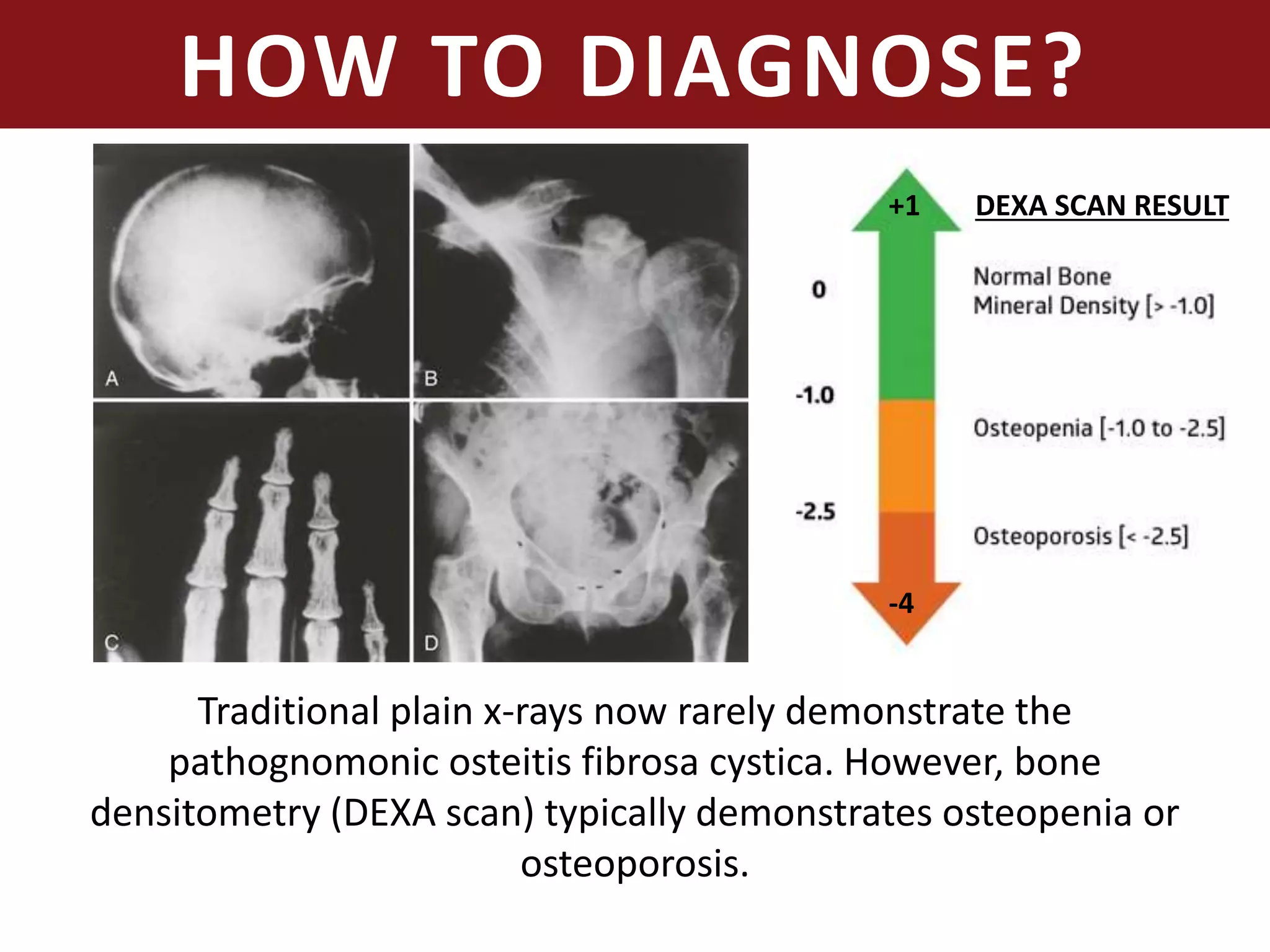HOW TO DIAGNOSE?
Traditional plain x-rays now rarely demonstrate the
pathognomonic osteitis fibrosa cystica. However, bone
densitometry (DEXA scan) typically demonstrates osteopenia or
osteoporosis.
-4
+1 DEXA SCAN RESULT
 