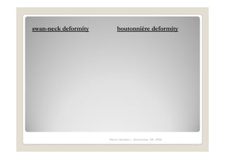 swan-neck deformity       boutonnière deformity




                      Maria Carmela L. Domocmat, RN, MSN
 