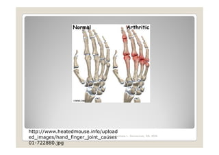 http://www.heatedmouse.info/upload
                              Maria Carmela L. Domocmat, RN, MSN
ed_images/hand_finger_joint_causes
01-722880.jpg
 