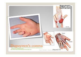 Dupuytren’s contracture
 http://advanceddynamic.com/Injuries-Conditions/Hand/Hand-Issues/Dupuytren-s-
 Contracture/a~285/article.html
http://www.med.und.edu/users/jwhiting/dupdef.html
                                                                   Maria Carmela L. Domocmat, RN, MSN
 