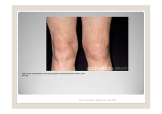 http://www.sciencephoto.com/image/265069/350wm/M3301436-Swollen_knee-
SPL.jpg




                                                              Maria Carmela L. Domocmat, RN, MSN
 
