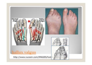 hallux valgus
http://www.rucosm.com/IMAGES/foot1.jpg
                           Maria Carmela L. Domocmat, RN, MSN
 