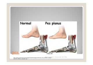 pes planus or flat feet
                                                                  Maria Carmela L. Domocmat, RN, MSN
http://www.eorthopod.com/images/ContentImages/child/child_foot_flatfoot_congeni
tal/child_flatfoot_causes01.jpg
 