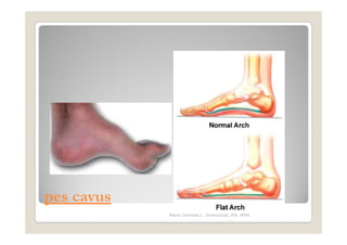 pes cavus
            Maria Carmela L. Domocmat, RN, MSN
 