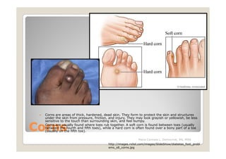 Corns are areas of thick, hardened, dead skin. They form to protect the skin and structures
  under the skin from pressure, friction, and injury. They may look grayish or yellowish, be less
  sensitive to the touch than surrounding skin, and feel bumpy.

Corns
  Corns are usually found where toes rub together. A soft corn is found between toes (usually
  between the fourth and fifth toes), while a hard corn is often found over a bony part of a toe
  (usually on the fifth toe).

                                                             Maria Carmela L. Domocmat, RN, MSN
                                         http://images.rxlist.com/images/SlideShow/diabetes_foot_probl
                                         ems_s8_corns.jpg
 