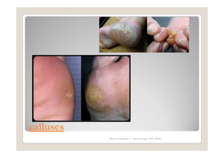 calluses
           Maria Carmela L. Domocmat, RN, MSN
 